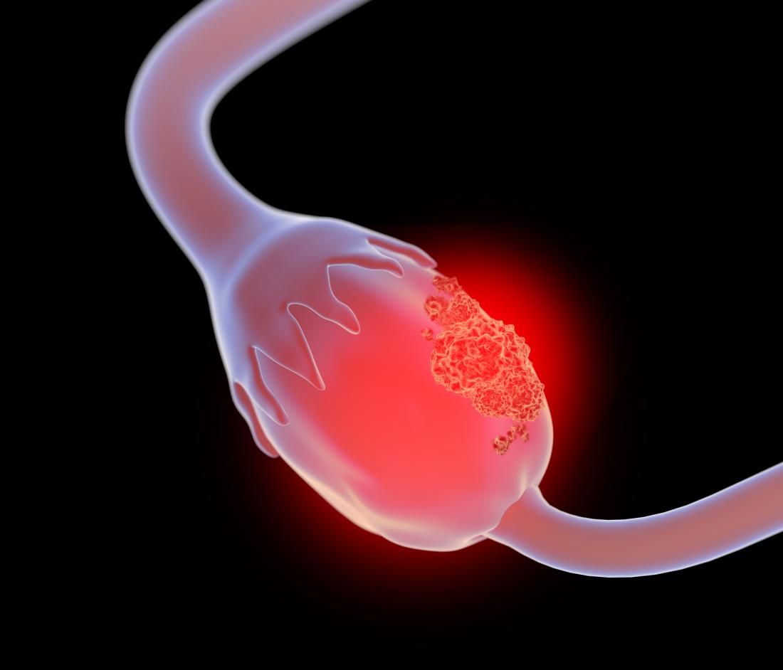 red illustration of ovarian cancer