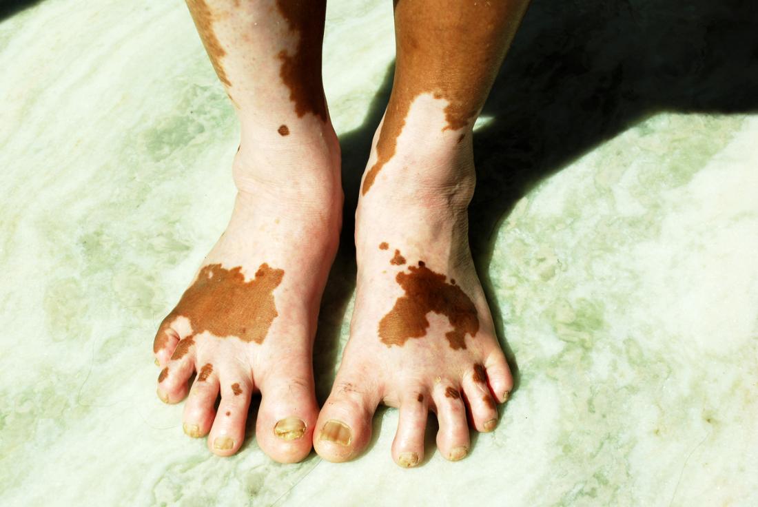 Vitiligo on feet.