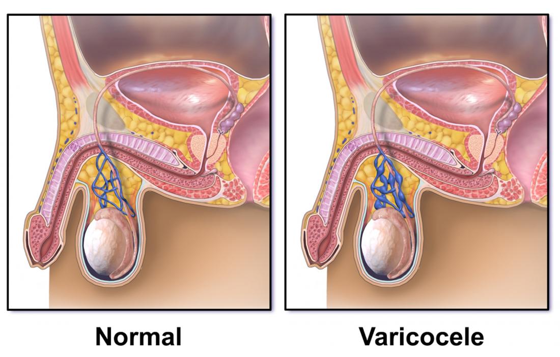 Diagram of a varicocele <br>Image credit: BruceBlaus, 2015</br>