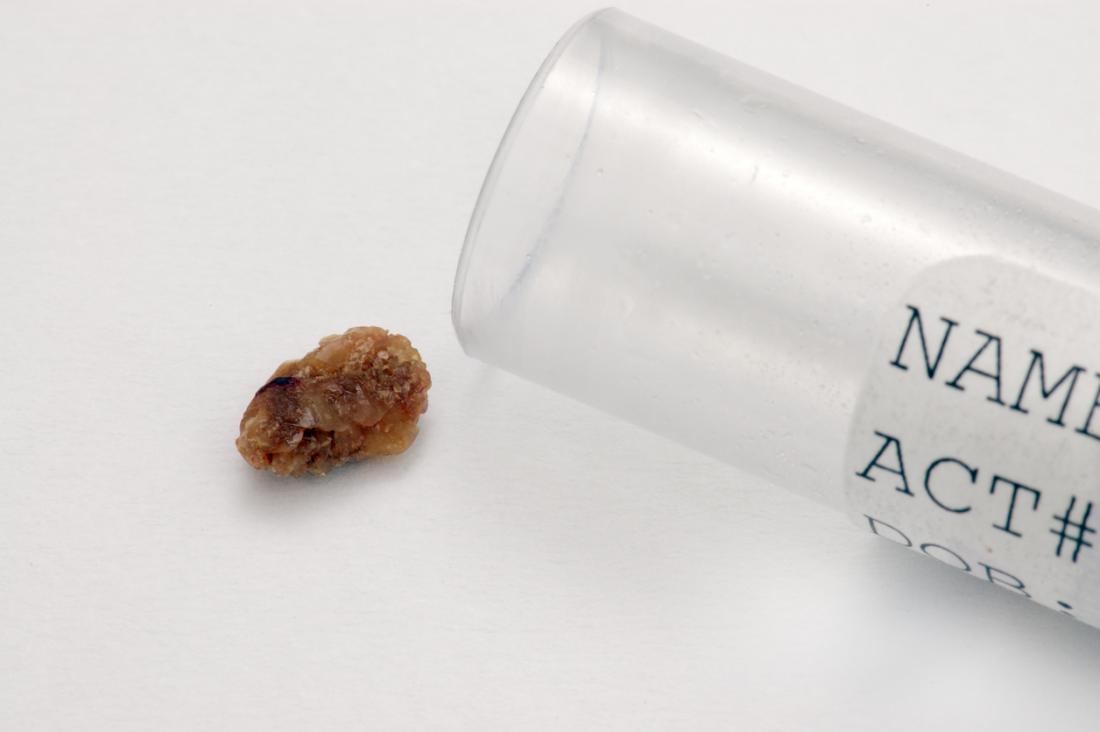 A kidney stone on a white background, with a sample beaker next to it.