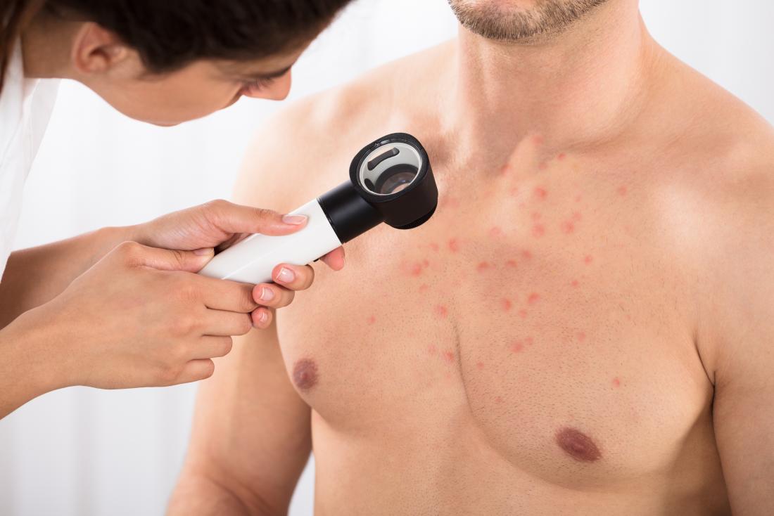 doctor examining man with acne on his chest