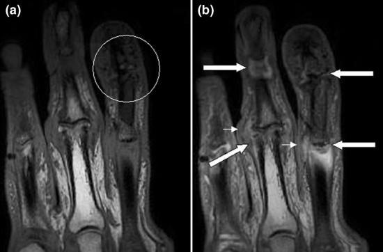 X-ray of psoriatic arthritis in hands.
