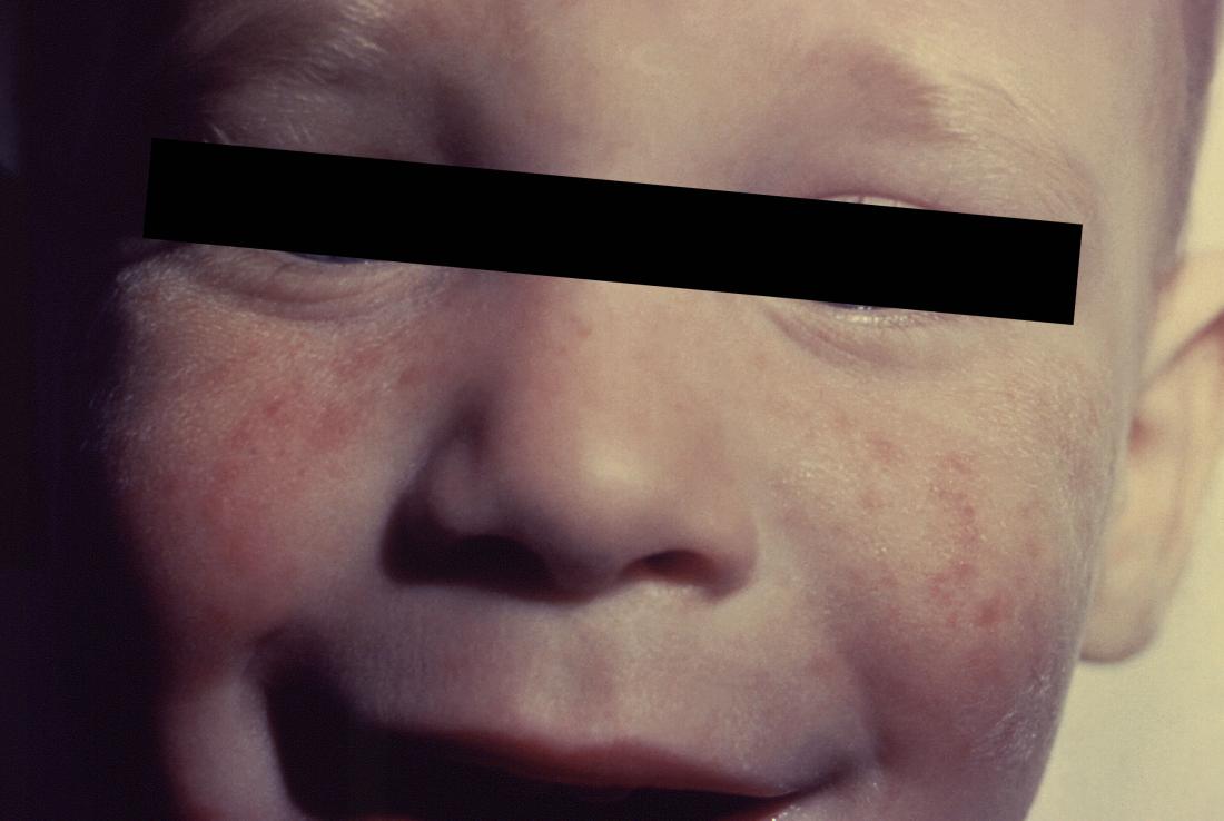 meningitis rash picture. Image credit: CDC/ Heinz F. Eichenwald, MD, 1958.