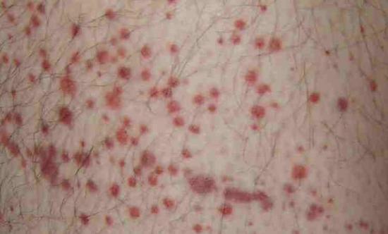 Meningitis Purpura rash. rash Image credit: Hektor, 2006.