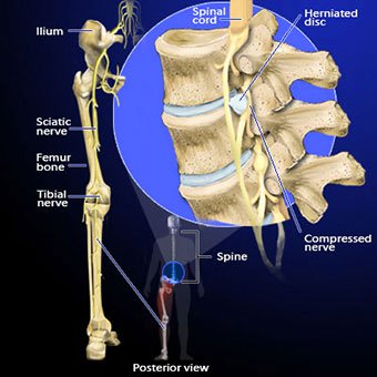 Illustration of sciatica caused by disc herniation.
