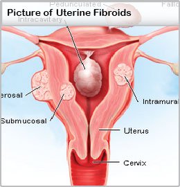 Picture of Uterine Fibroids