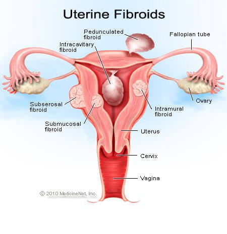 Picture of uterine fibroids