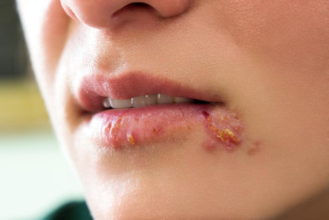 Herpes around mouth and lips