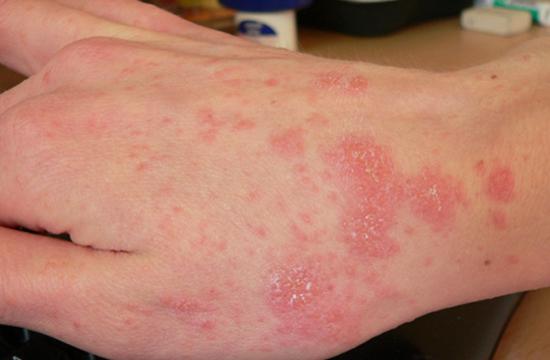 Scabies on hand skin