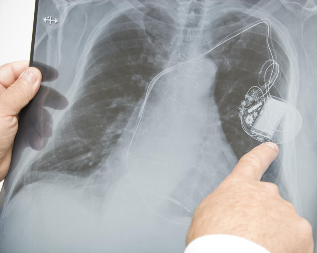 X-ray showing a heart pacemaker
