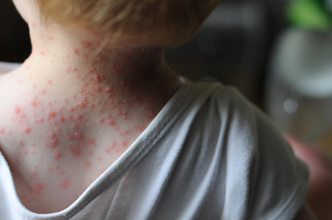 Child with chicken pox rash on back of neck