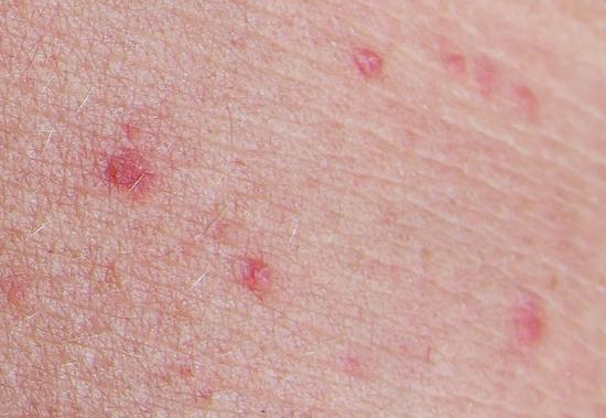 Miliaria rash on skin. Image credit: Jurfeld, 2018.