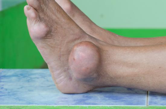 Gout can cause severe swelling and pain.