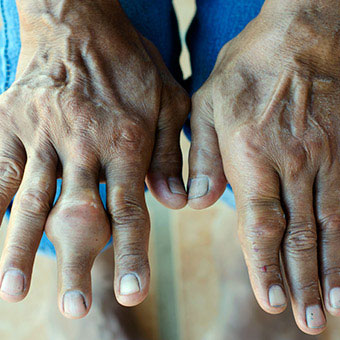 A person suffering from RA has multiple swollen joints on both hands and wrists.