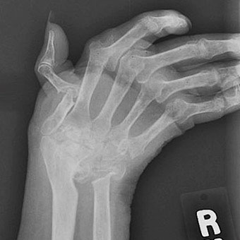 A radiograph of the hand of a 71-year-old woman with rheumatoid arthritis (RA) shows joint deformity.