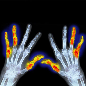 This X-ray of hands affected by rheumatoid arthritis (RA) shows colorized symmetry of affected joints on both hands.