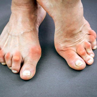Red, inflamed toe joints may indicate rheumatoid arthritis.