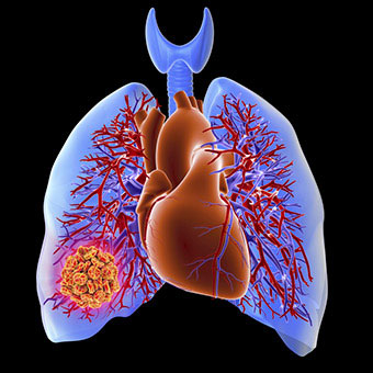 Some lung conditions and cancers cause chest pain.