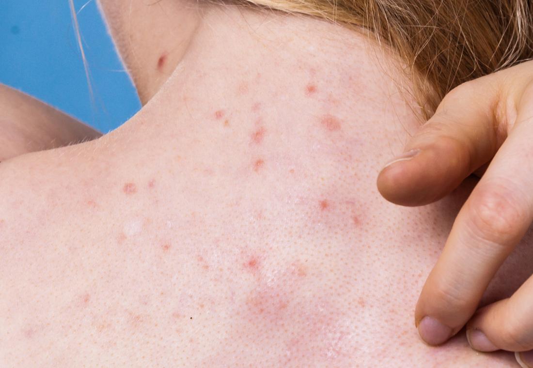 Acne on back and neck