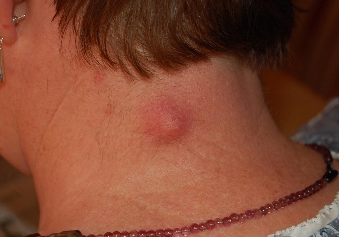 Epidermoid cyst aka epidermal inclusion cyst or sebaceous cyst on back of neck. Image credit: Steven Fruitsmaak, 2010.