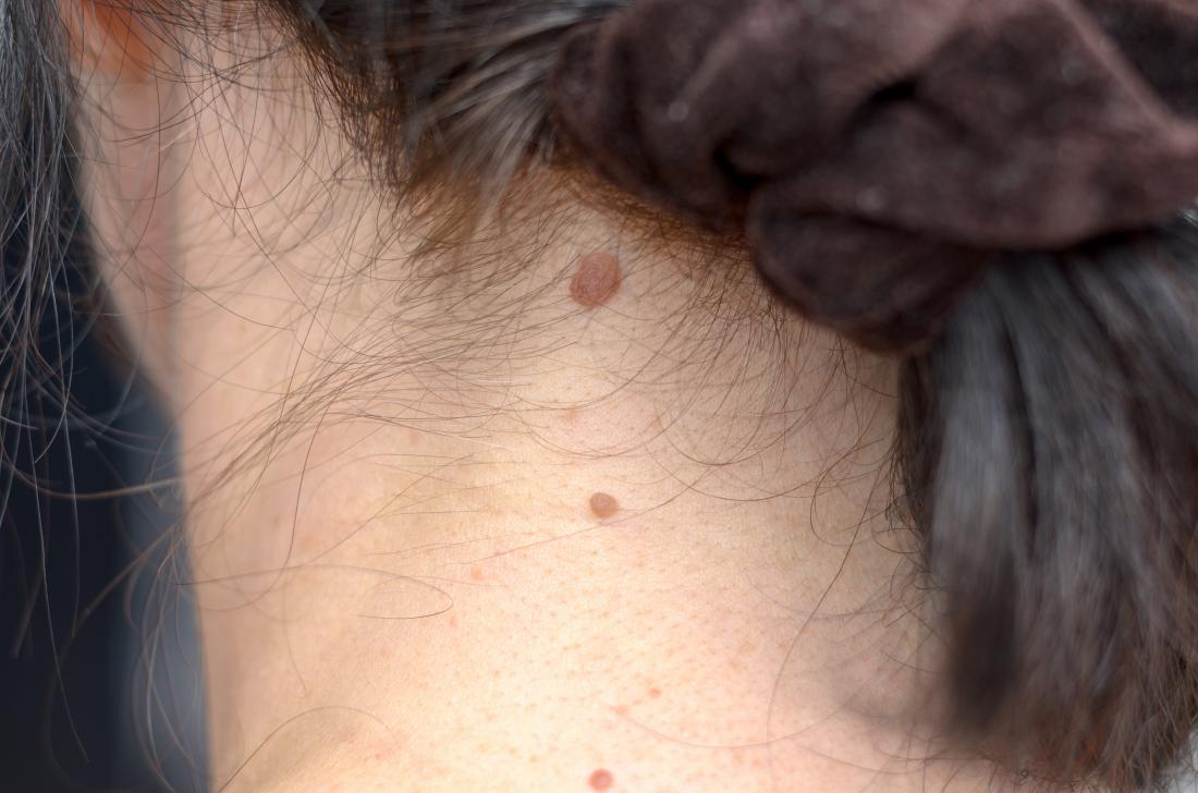 Moles on back of neck