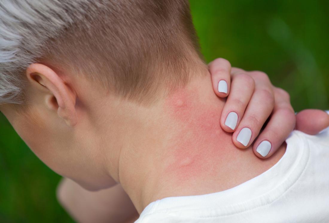 allergic reaction on back of neck.