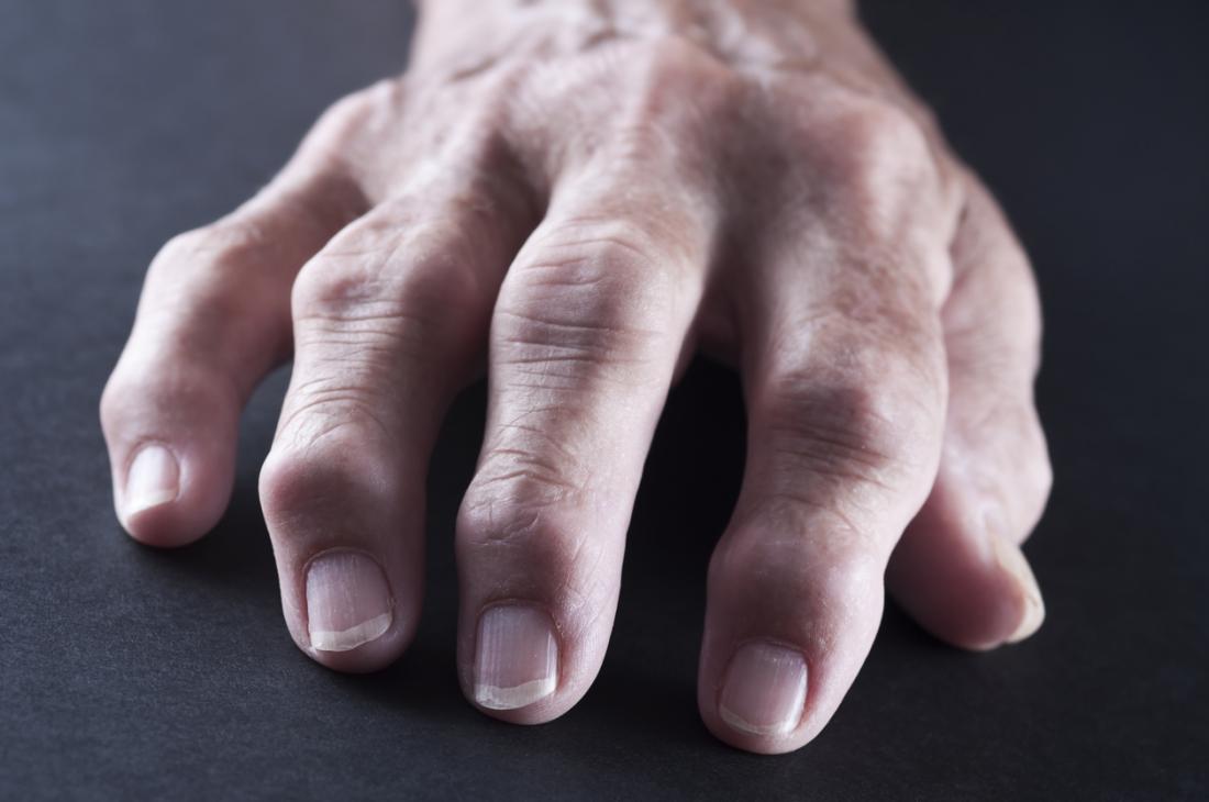 Rheumatoid arthritis affecting fingers