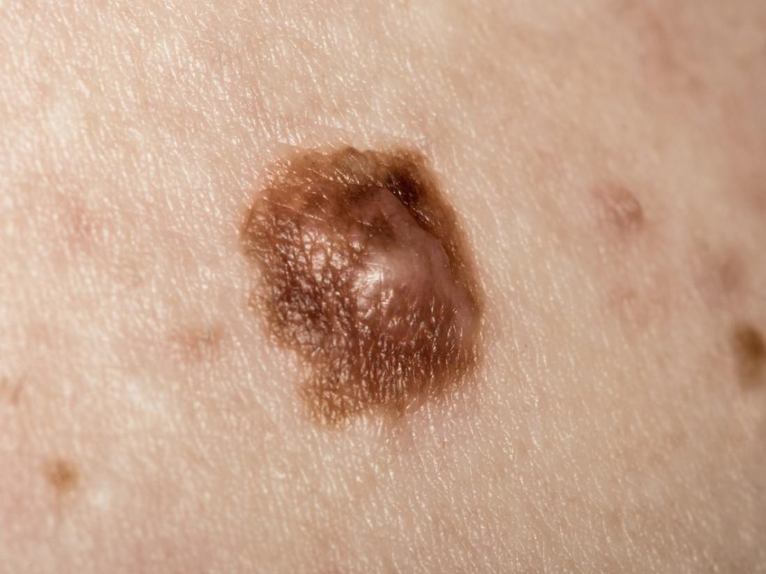 A cancerous mole may have an irregular border.