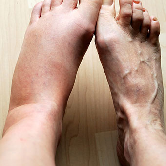 Painful foot swelling and ankle swelling can result from pregnancy, injury, or other medical diseases and conditions.