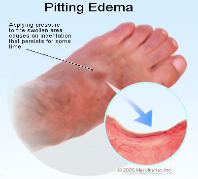 Picture of Pitting Edema