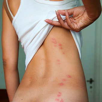A female has bedbug bites on her back.