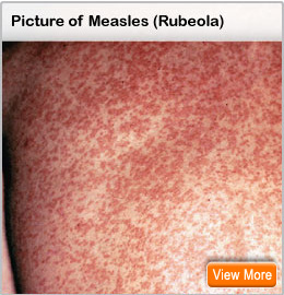 Picture of measles rash