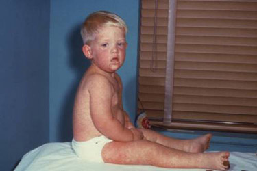 Picture of a child with measles skin rash