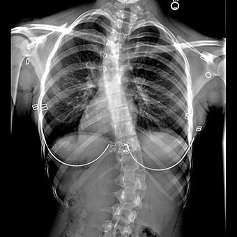 X-ray of girl, age 16, with scoliosis.