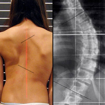 A female with scoliosis shows curvature of the spine.