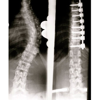 Surgical result after ventral fusion of scoliosis.