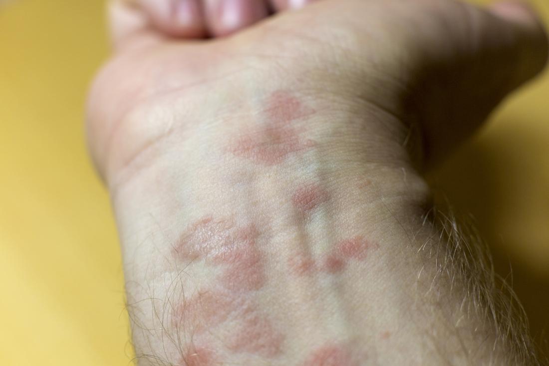 Eczema can cause patches of dry skin across the body.