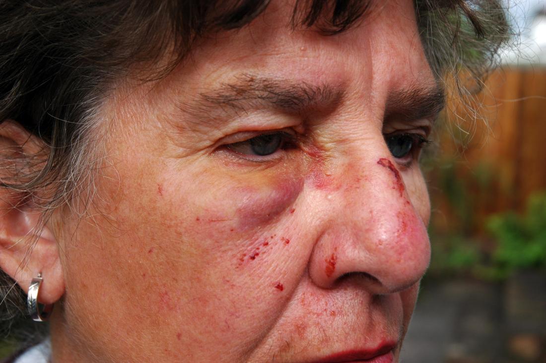 Mature woman with bruised and broken face.