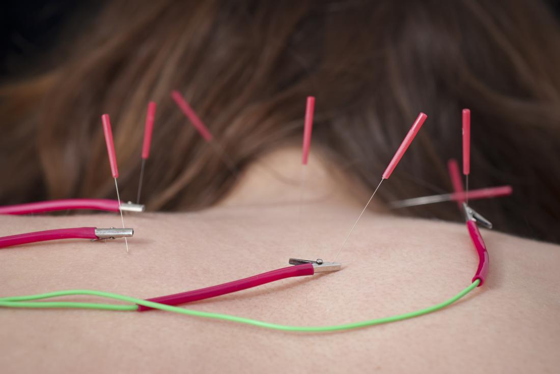 woman having electrical stimulation acupuncture on neck and shoulders