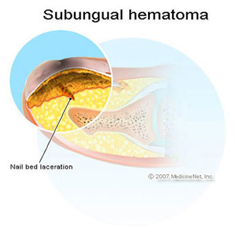An illustration of a subungual hematoma of the fingernail.