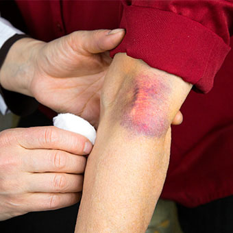 A doctor examines a large hematoma on a patient’s arm.