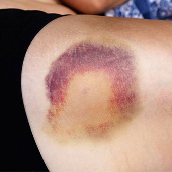 A black and blue hematoma fades to yellow as it heals.