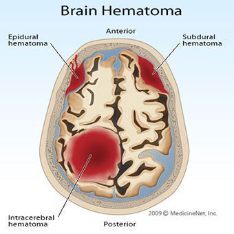 An illustration of subdural and epidural hematomas in the brain.