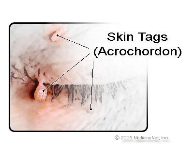 Picture of skin tags on the eyelid
