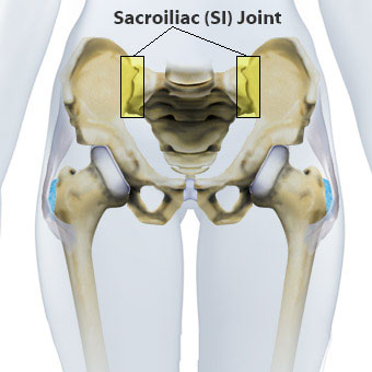 An illustration of the sacroiliac (SI) joints.