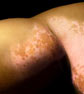 What does vitiligo look like?