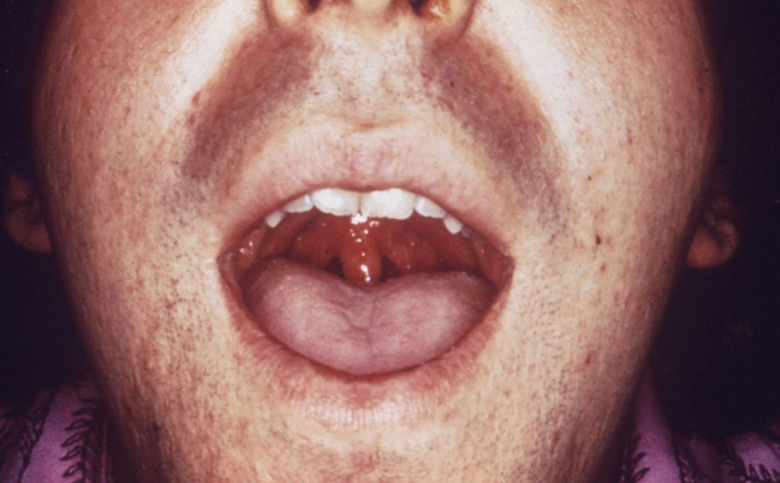 Gonorrhea. Image credit: CDC/ Dr. N. J. Flumara, Dr. Gavin Hart,1976.