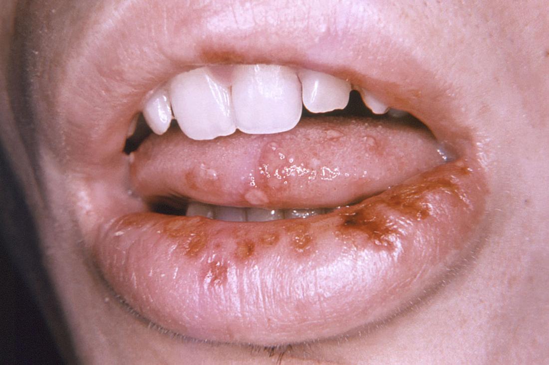 Herpes lesions on lips and tongue in mouth. Image credit: CDC/ Robert E. Sumpter, 1967.