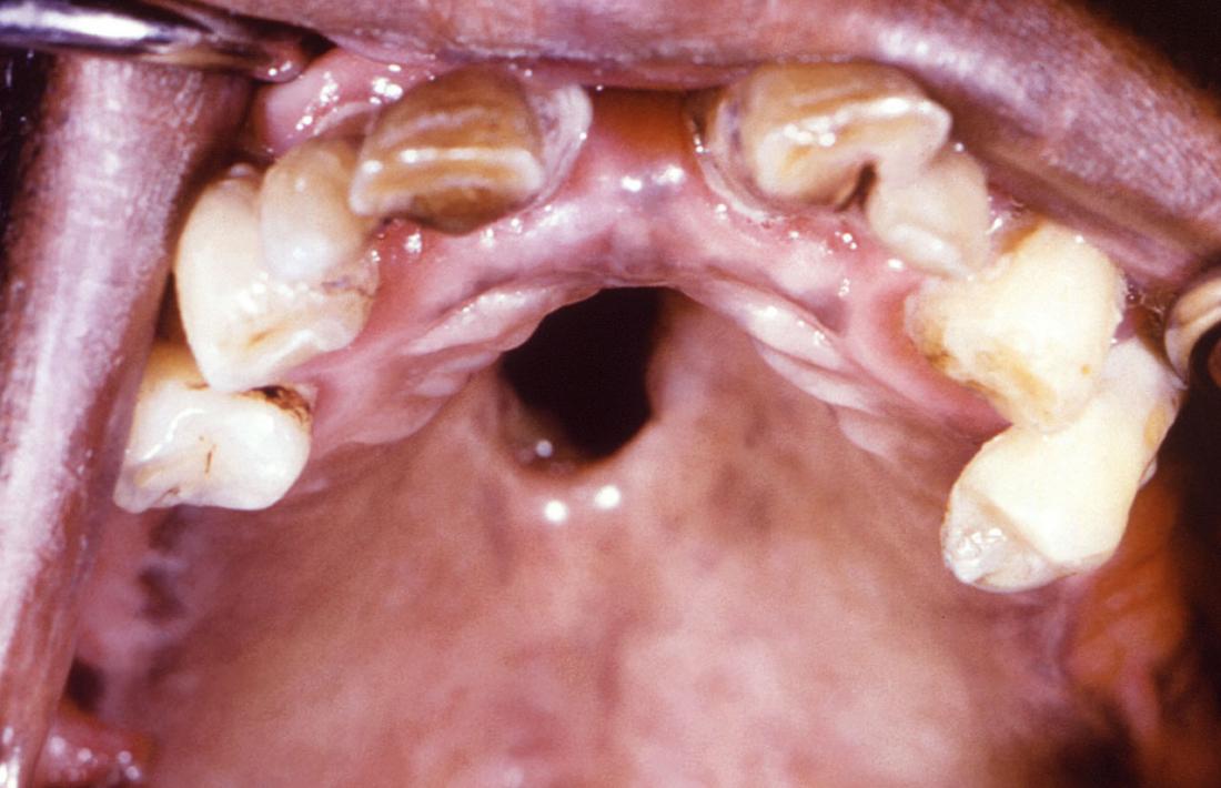 Gonorrhea affecting roof of mouth. Image credit: CDC/ Robert E. Sumpter, 1967.