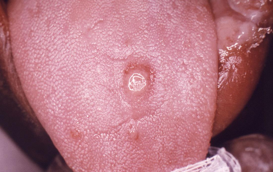 Tongue lesions in syphilis. Image credit: CDC/ Robert E. Sumpter, 1967.